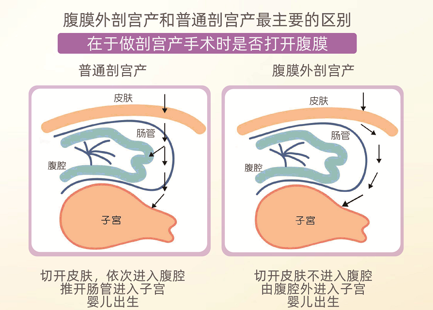 腹膜外剖宫产